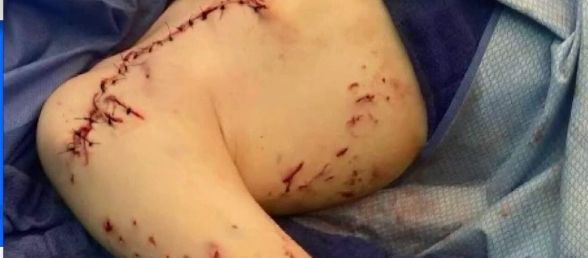 ‘A shark tried to eat me:’ 9-year-old boy recovering after bite at Florida beach
