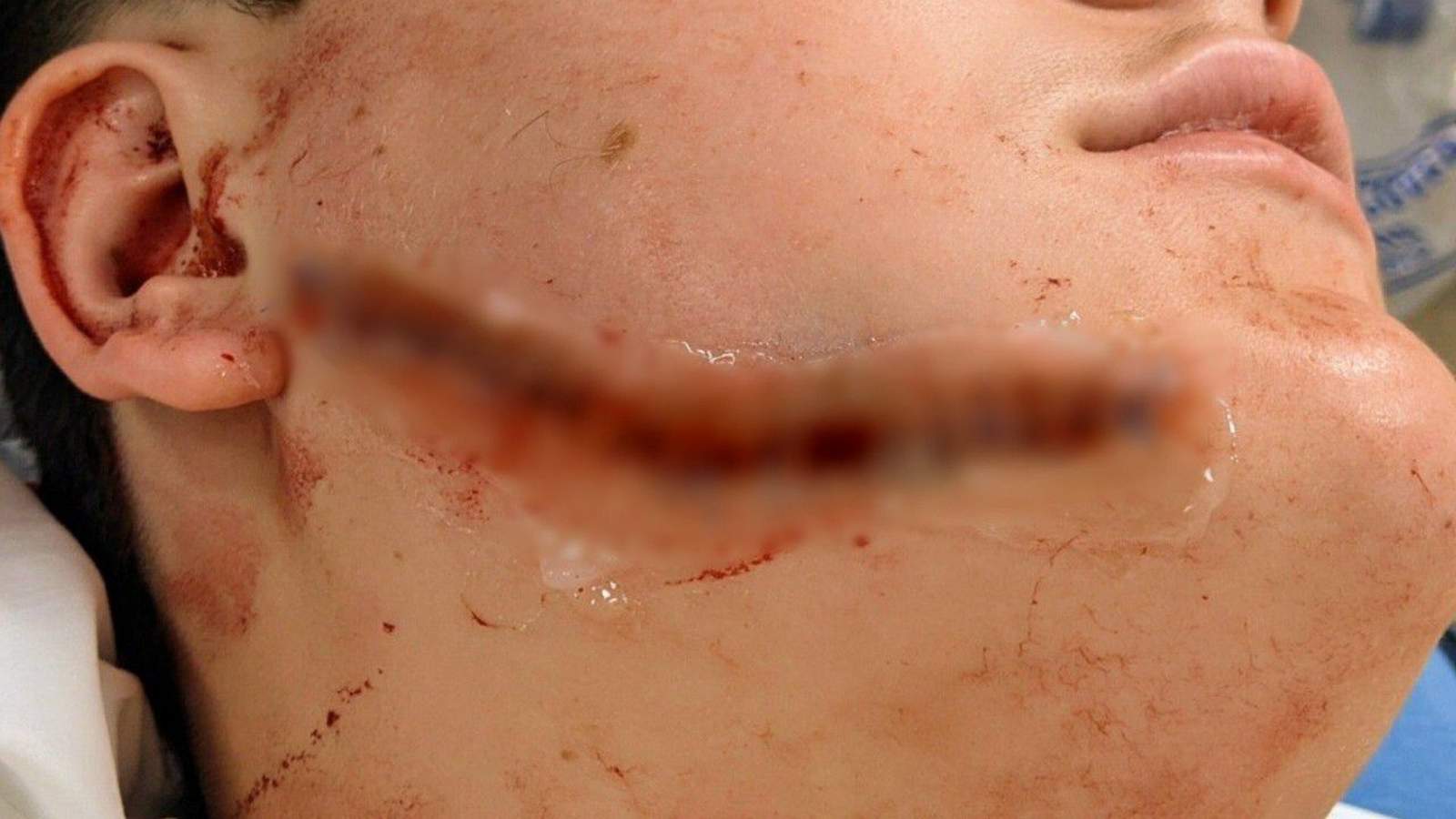 Teen’s face slashed in apparent random attack in Orange City