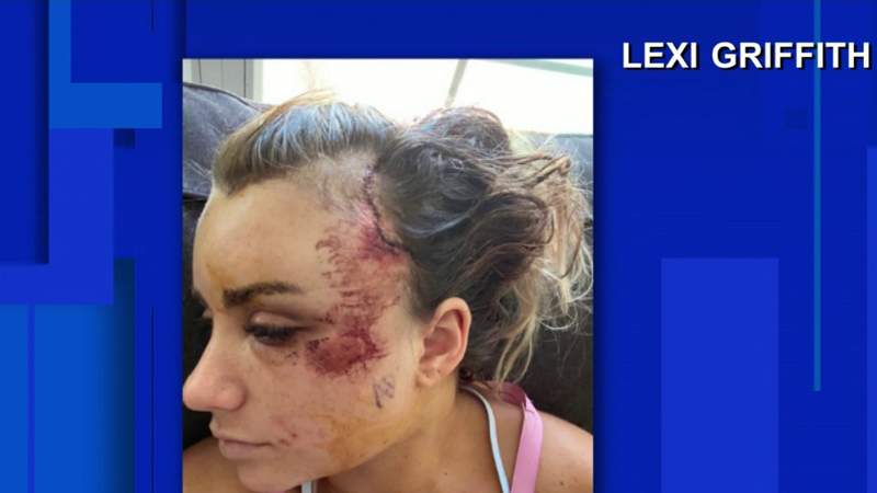 ‘My hair got caught in a tire and ripped my hair and scalp off:’ hit-and-run victim says she needed 50 stiches