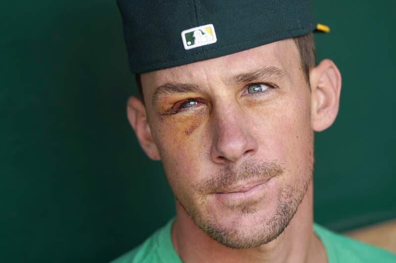 Bassitt to start for A's, 5 weeks after being hit in head